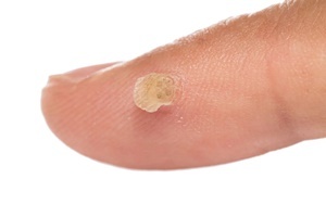 A wart is a skin disease, with which to fight effectively Skincell Pro